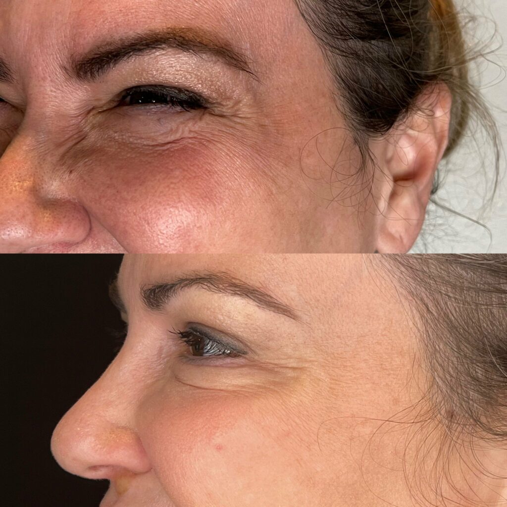botox crows feet