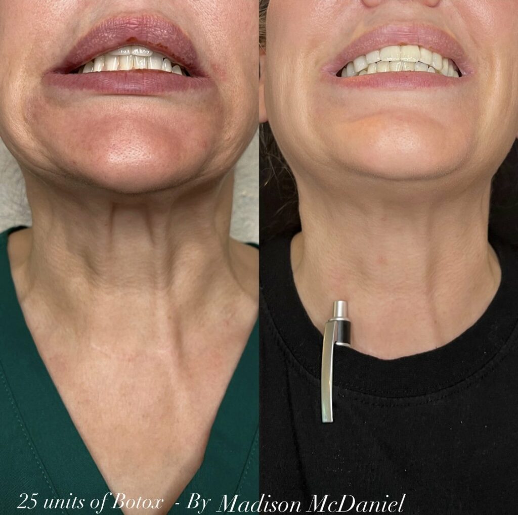 Platysmal Bands Botox before and after