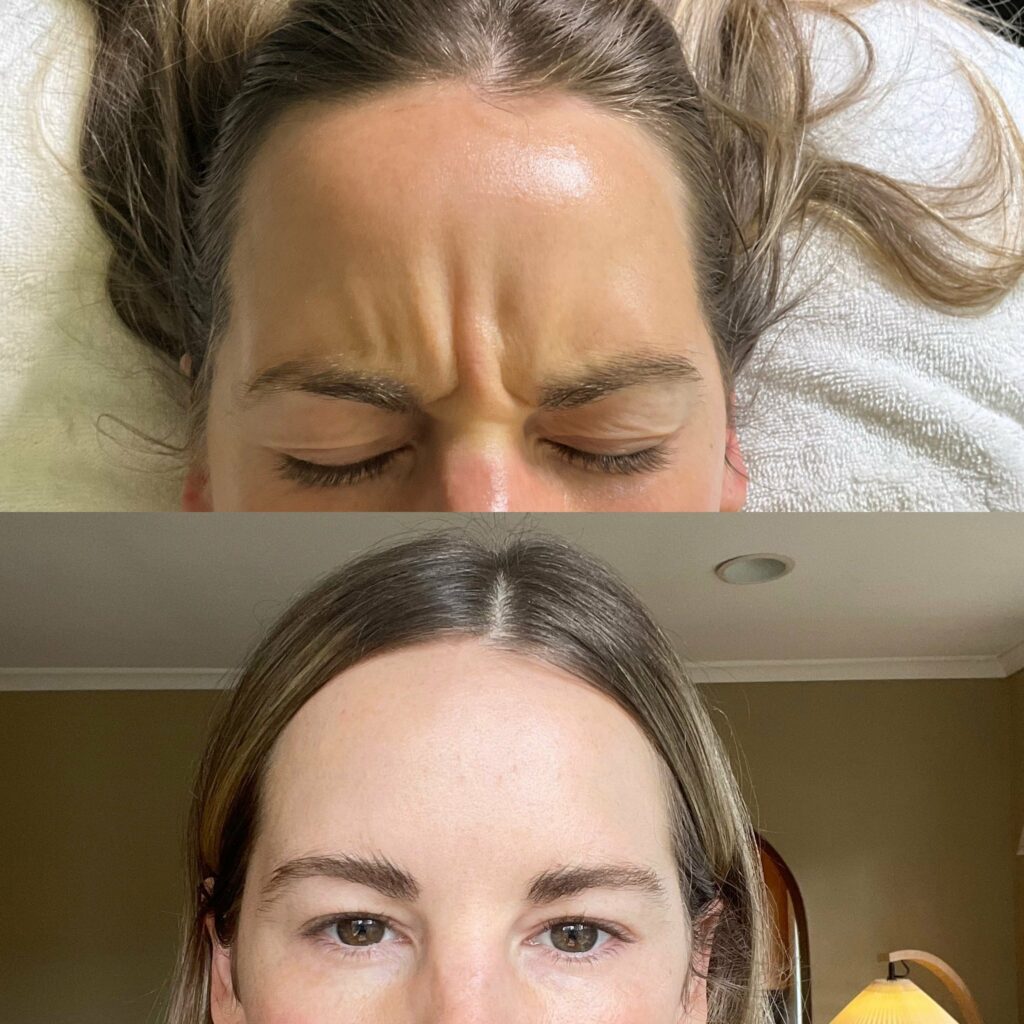 11's botox before and after