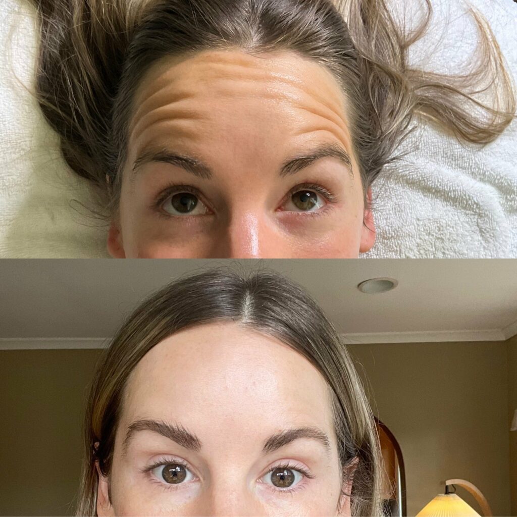 botox in forehead before and after