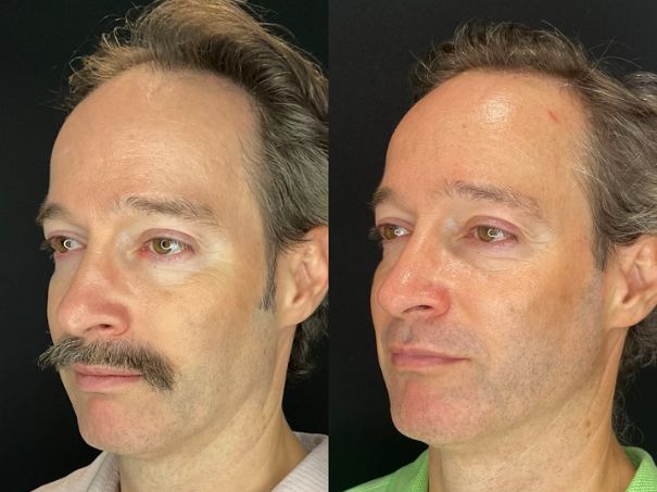 Male before and after sculptra treatment