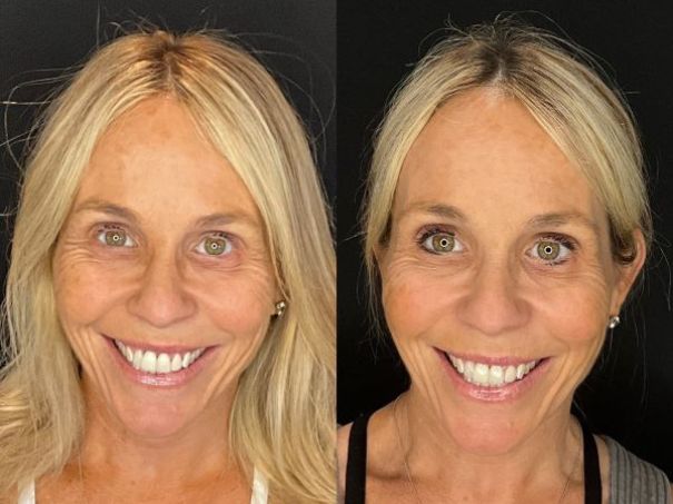 woman before and after sculptra treatment